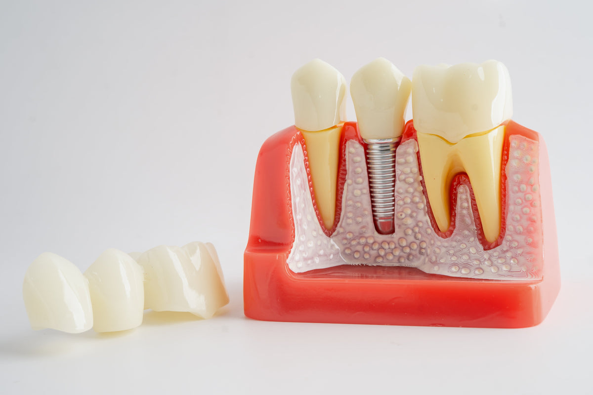 What Are Alternatives to Dental Implants?