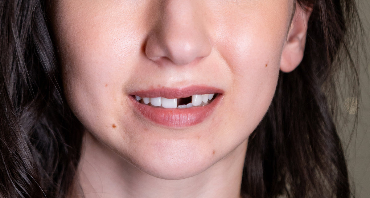 Why Replace A Missing Tooth?