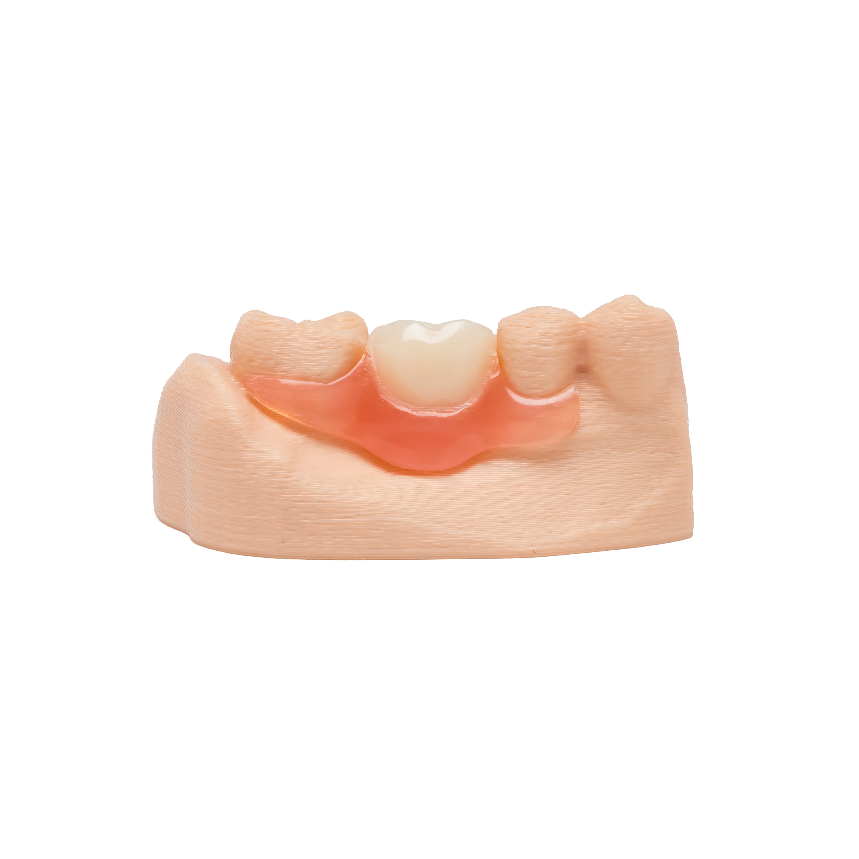 One Tooth Lower Flexible Partial Denture Flipper