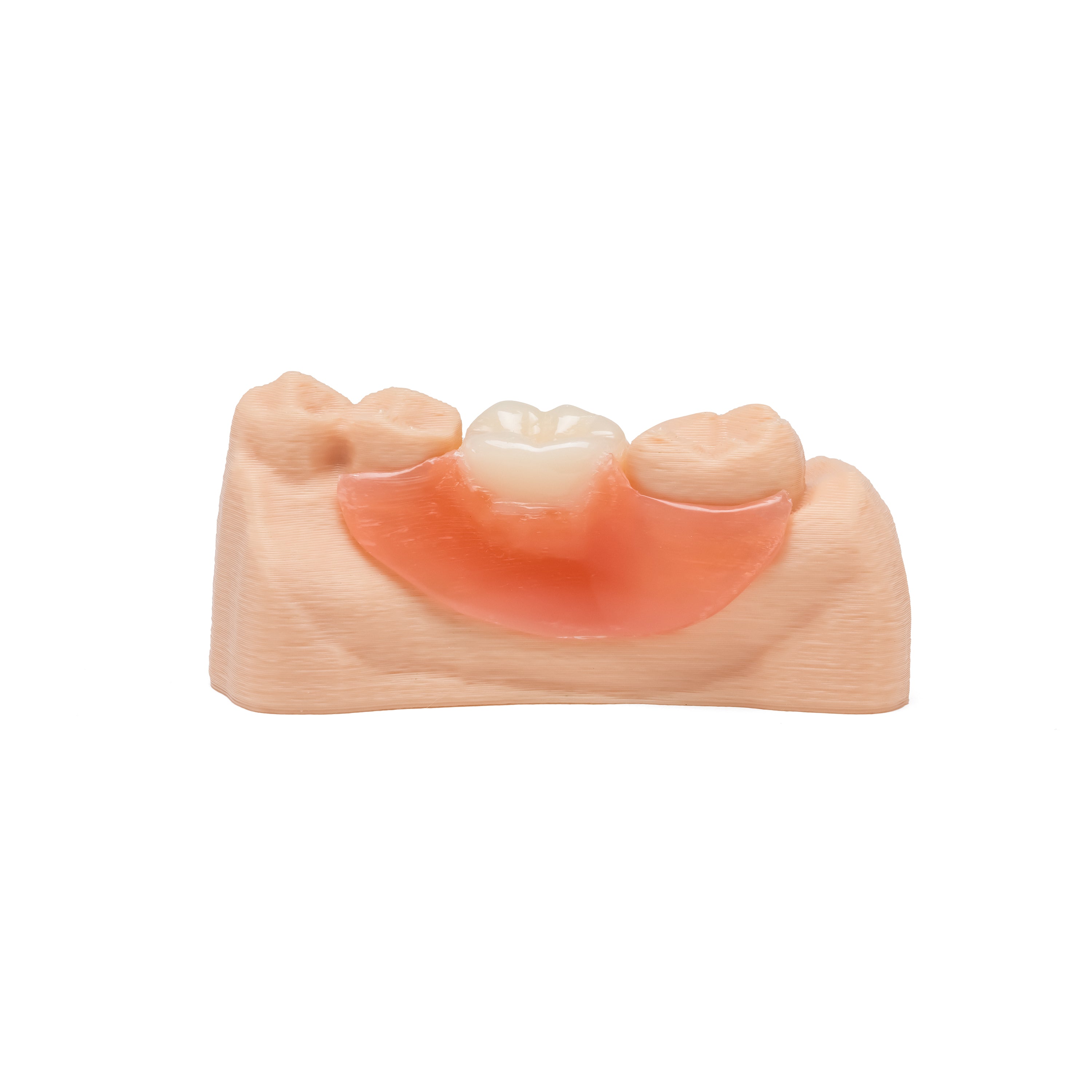 One Tooth Lower Flexible Partial Denture Flipper